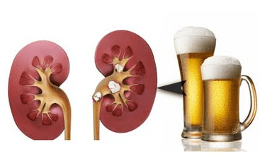 El efecto del alcohol en los riñones